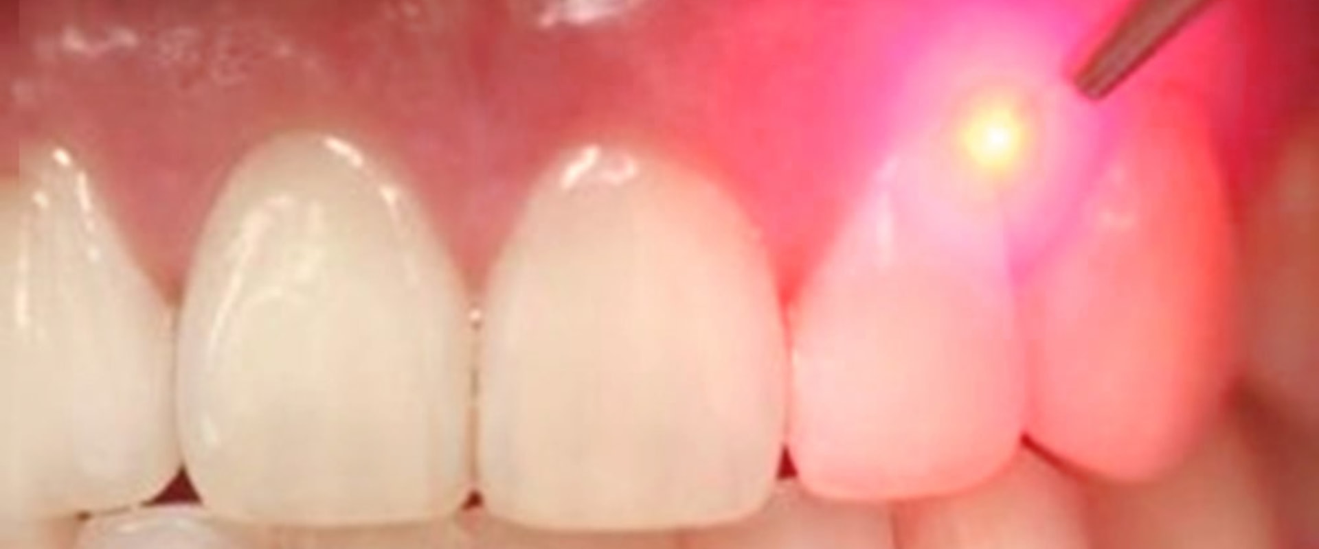 How Long Do The Results Of A Dental Laser Cleaning Last how-long-do-the-results-of-a-dental-laser-cleaning-last
