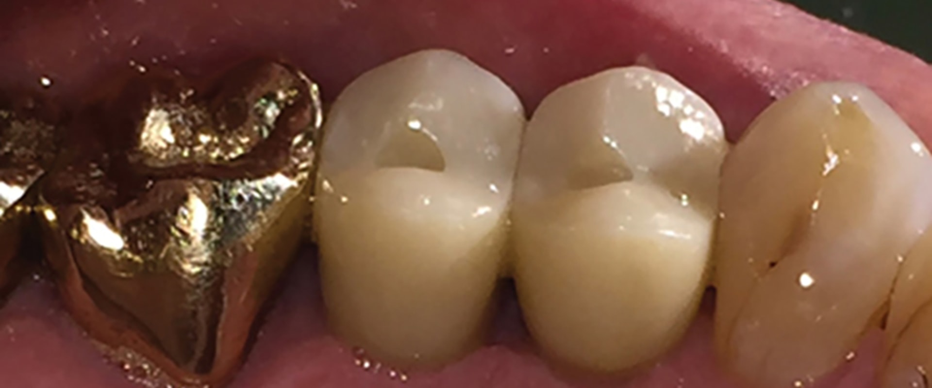 What to Avoid After Laser Dental Cleaning