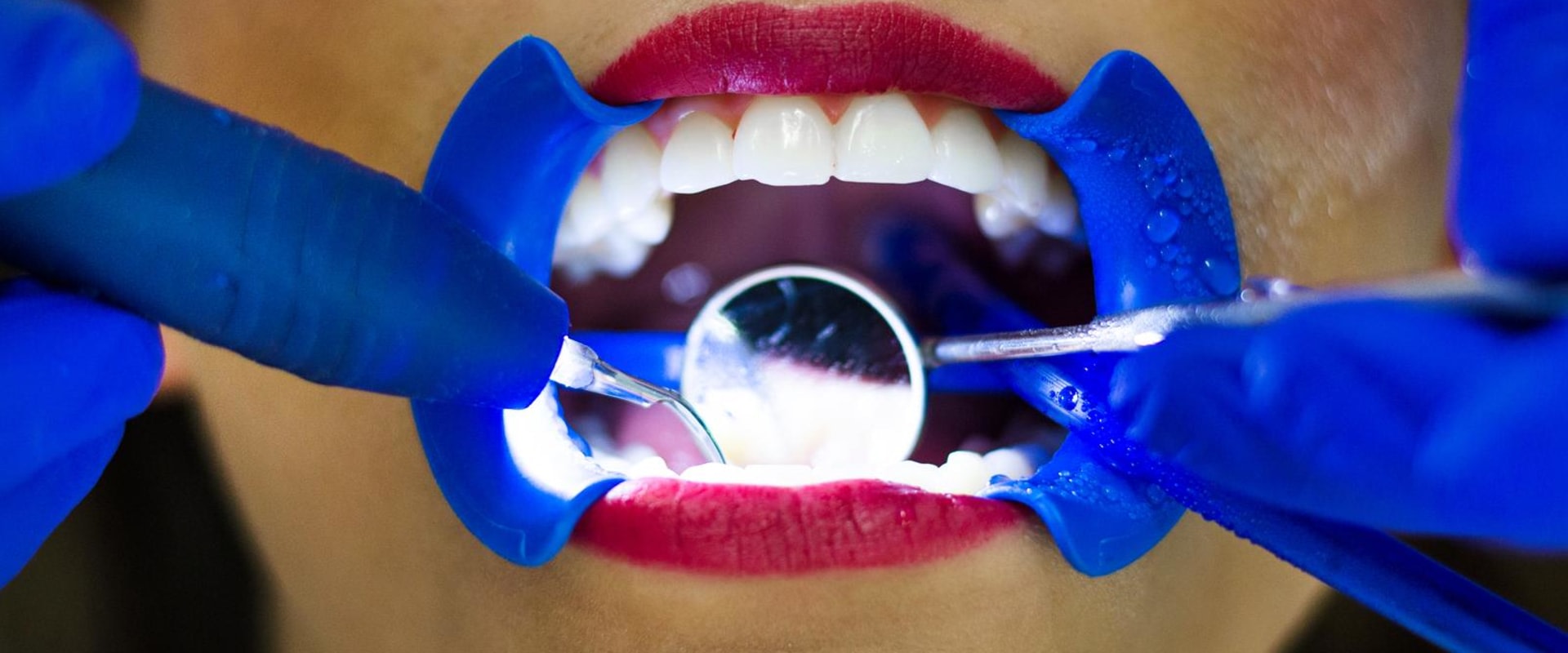 Why You Should Choose Dental Laser Cleaning For Your Next Appointment