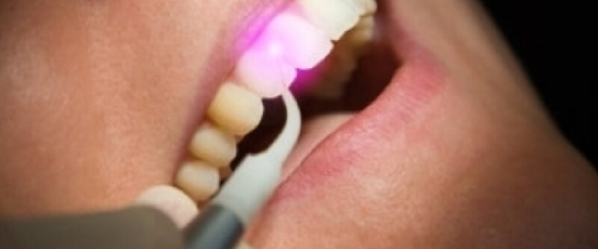 Dental Laser Cleaning In Austin A Safe And Effective Solution For Your Teeth