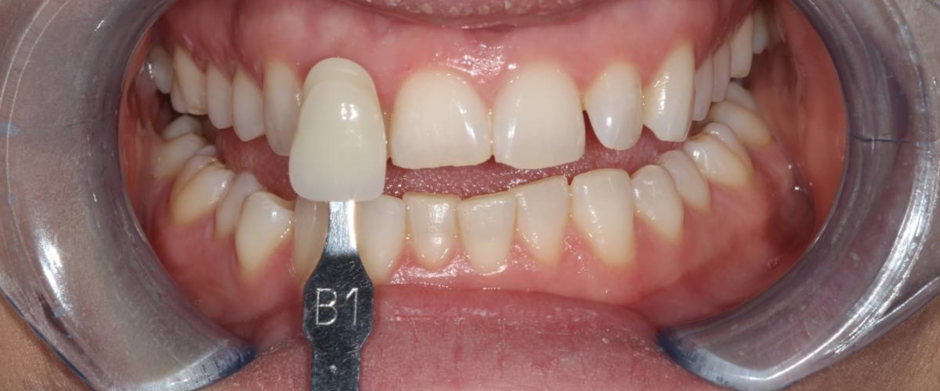 Can You Eat After a Laser Dental Cleaning?