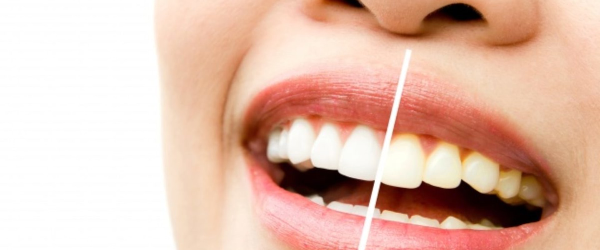 Is Laser Deep Cleaning Teeth Safe? A Comprehensive Guide