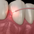 Can Laser Therapy Treat Periodontal Disease?