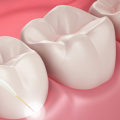 Can I Get a Dental Laser Cleaning if I Have a Crown or Bridge?
