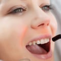 The Benefits of Laser Teeth Cleaning