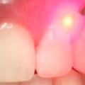 How Long Do the Results of a Dental Laser Cleaning Last?