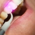 Dental Laser Cleaning In Austin: A Safe And Effective Solution For Your Teeth