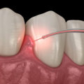 What are the Benefits of Laser Teeth Cleaning?