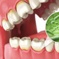 A Gentle And Effective Solution: Dental Laser Cleaning For Tartar Removal In London