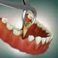 Tooth Extraction in Kilchberg: From Dental Laser Cleaning to Effective Tooth Removal