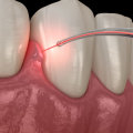 How Often Should I Get a Dental Laser Cleaning?