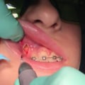 Can I Get a Dental Laser Cleaning with Braces?