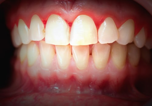 How Often Should You Brush and Floss After a Dental Laser Cleaning?