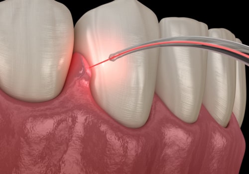 What Type of Laser is Used for Dental Cleaning?