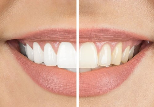 Achieve A Brighter Smile With Dental Laser Cleaning In Austin, TX